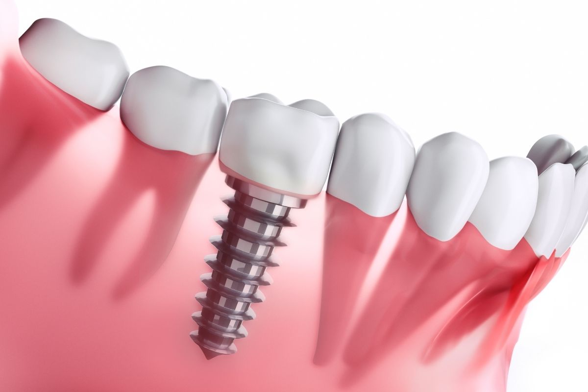 İmplant tedavisi öncesi çene kemiği değerlendirmesi ve implant planlama sürecini gösteren bilgilendirici diş hekimliği görseli.
