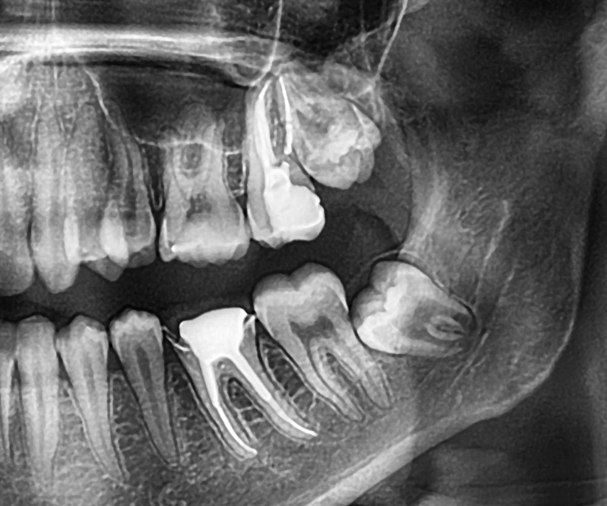 Gömülü 20’lik dişin panoramik röntgen görüntüsü ve cerrahi çekim sürecini gösteren bilgilendirici görsel.