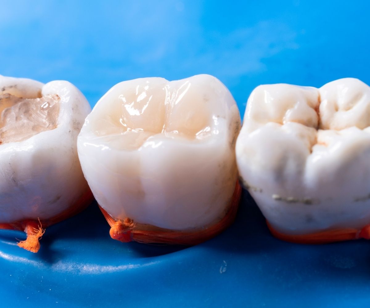 Kompozit, amalgam ve inley-onley diş dolgularının uygulama aşamalarını ve dişle uyumunu gösteren bilgilendirici görsel.