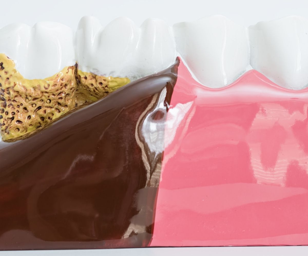 Diş eti hastalıklarının muayene, diş taşı temizliği ve periodontal tedavi sürecini gösteren bilgilendirici diş hekimliği görseli.