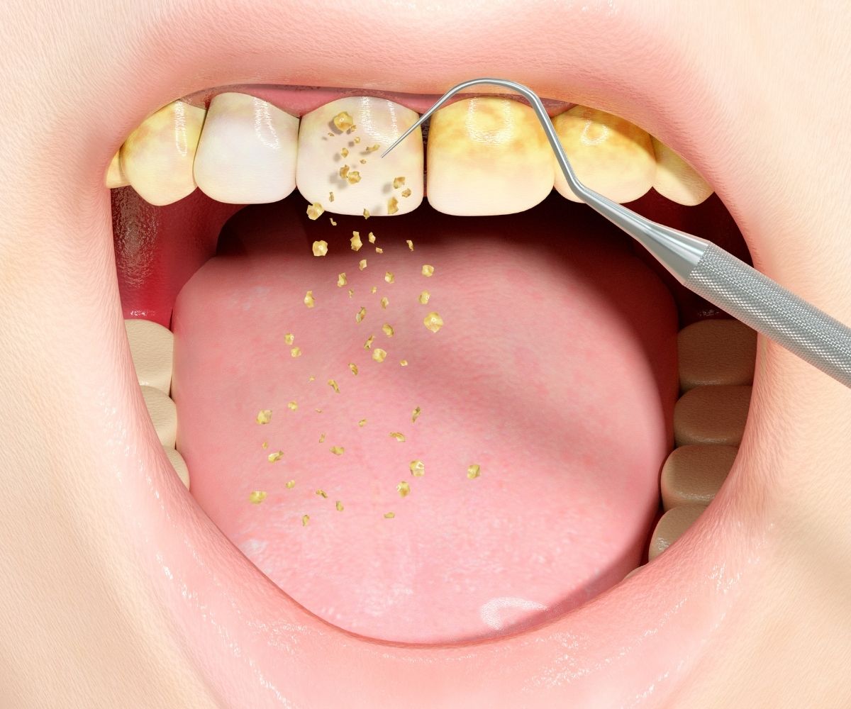 Ultrasonik cihazlarla yapılan diş taşı temizliği işlemini ve diş yüzeylerinin profesyonel olarak arındırılmasını gösteren görsel.