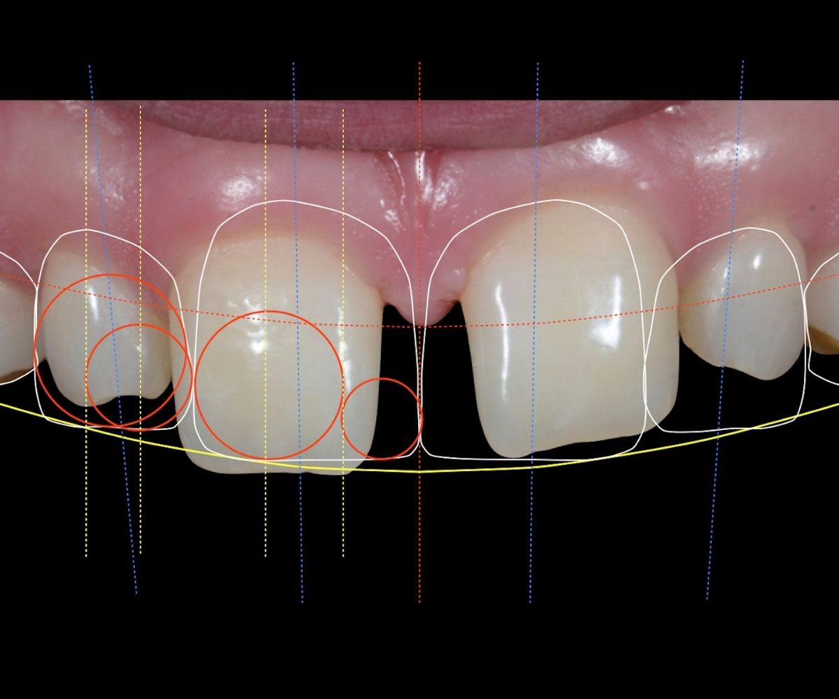 Gülüş tasarımı sürecinde diş, diş eti ve dudak uyumunun dijital analizle planlanmasını gösteren estetik diş hekimliği görseli.