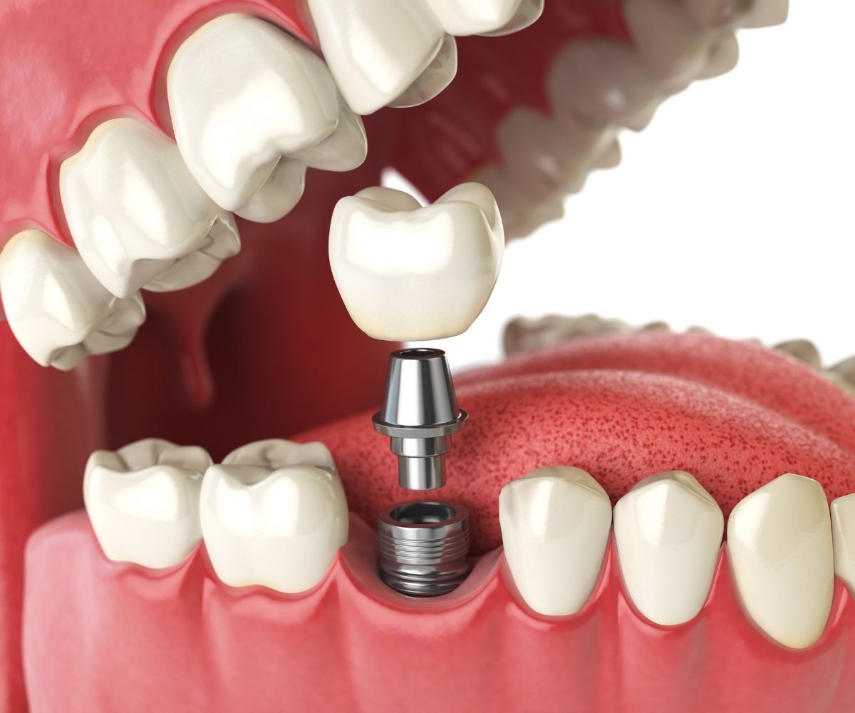 Çene kemiğine yerleştirilen dental implant ve üzerine uygulanan protez sürecini gösteren bilgilendirici diş hekimliği görseli.
