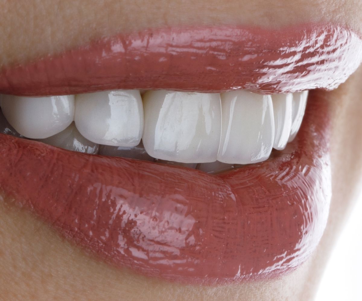 Ön dişlere uygulanan lamine diş kaplama tedavisinin estetik görünüm ve uyum sürecini gösteren bilgilendirici görsel.