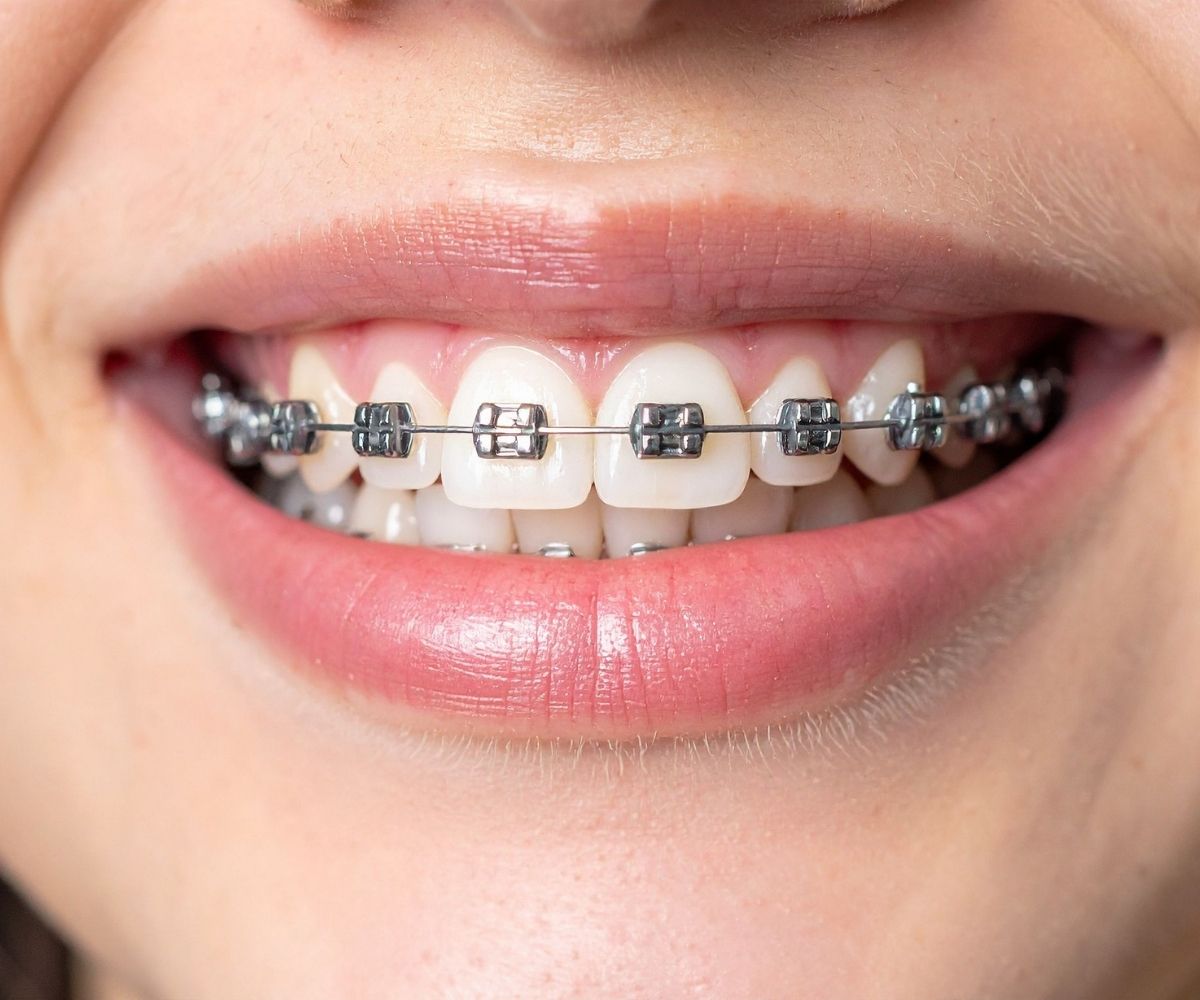 Konya ortodonti tedavisi kapsamında diş teli ve şeffaf plak uygulamalarının ortodontik muayene süreci