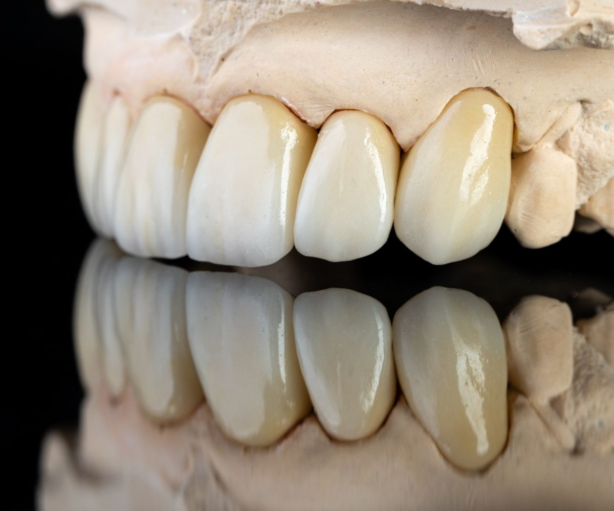 Zirkonyum diş kaplama uygulamasının diş üzerindeki estetik ve fonksiyonel uyumunu gösteren bilgilendirici klinik görsel.