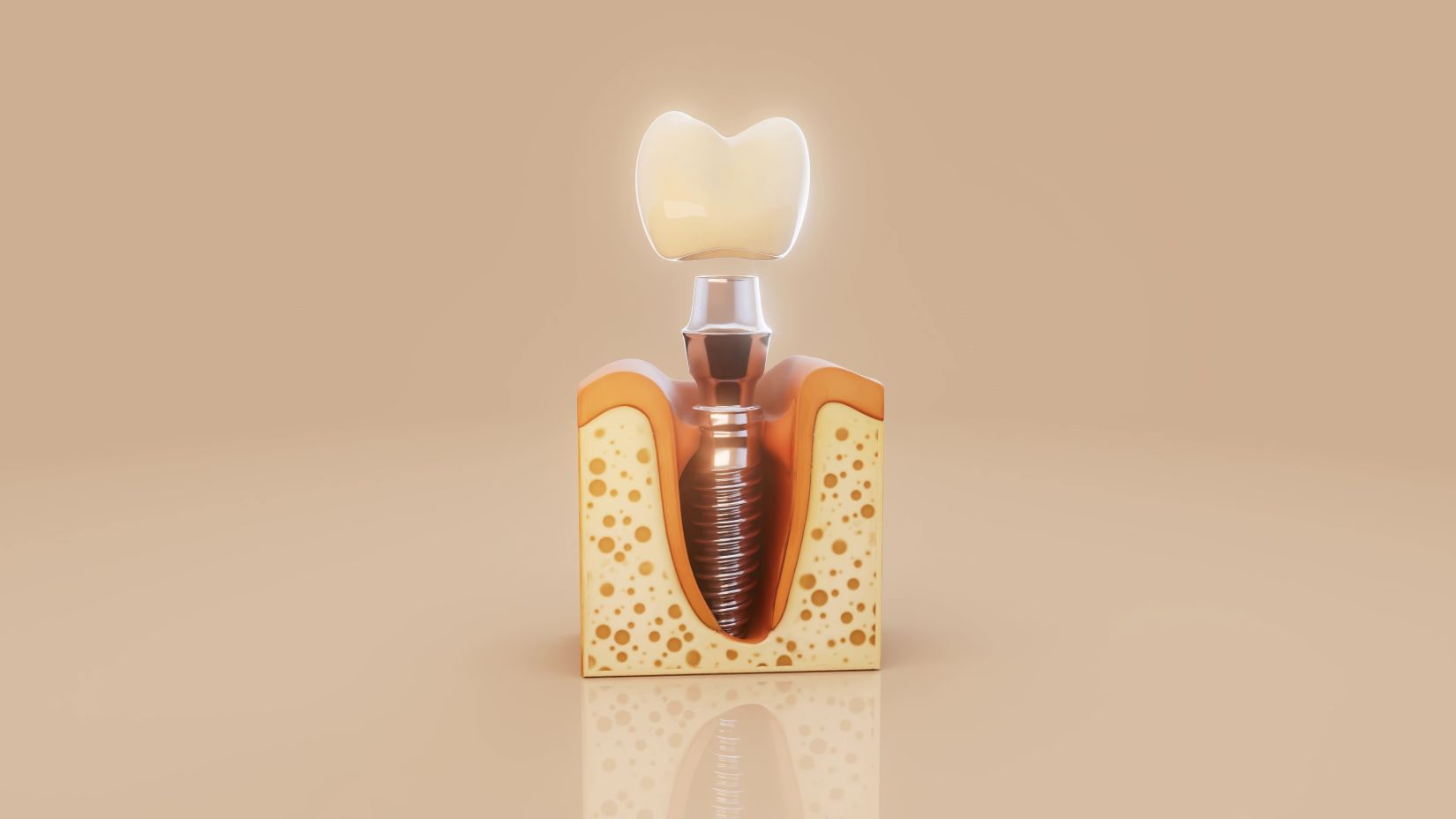 Dental implantın çene kemiği içine yerleştirilmesini gösteren şematik diş hekimliği görseli