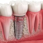 Aynı gün implant yerleştirme ve geçici diş uygulamasını gösteren diş hekimliği görseli