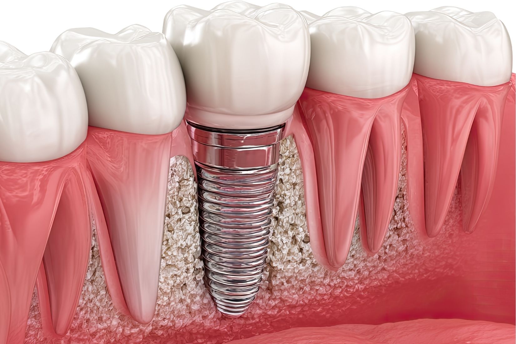 Aynı gün implant yerleştirme ve geçici diş uygulamasını gösteren diş hekimliği görseli