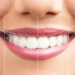 Gülüş tasarımında yüz oranları ve diş formunun analiz edildiği estetik diş hekimliği görseli