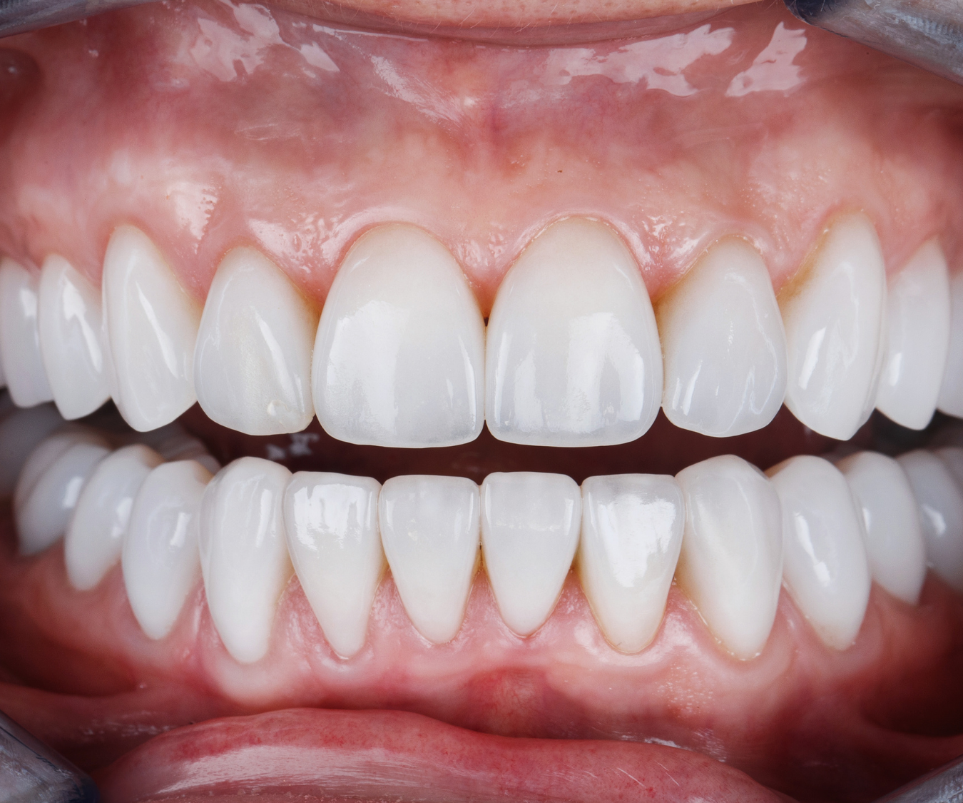 Konya Emax diş kaplama uygulaması sonrası ön dişlerde estetik seramik restorasyon görünümü.