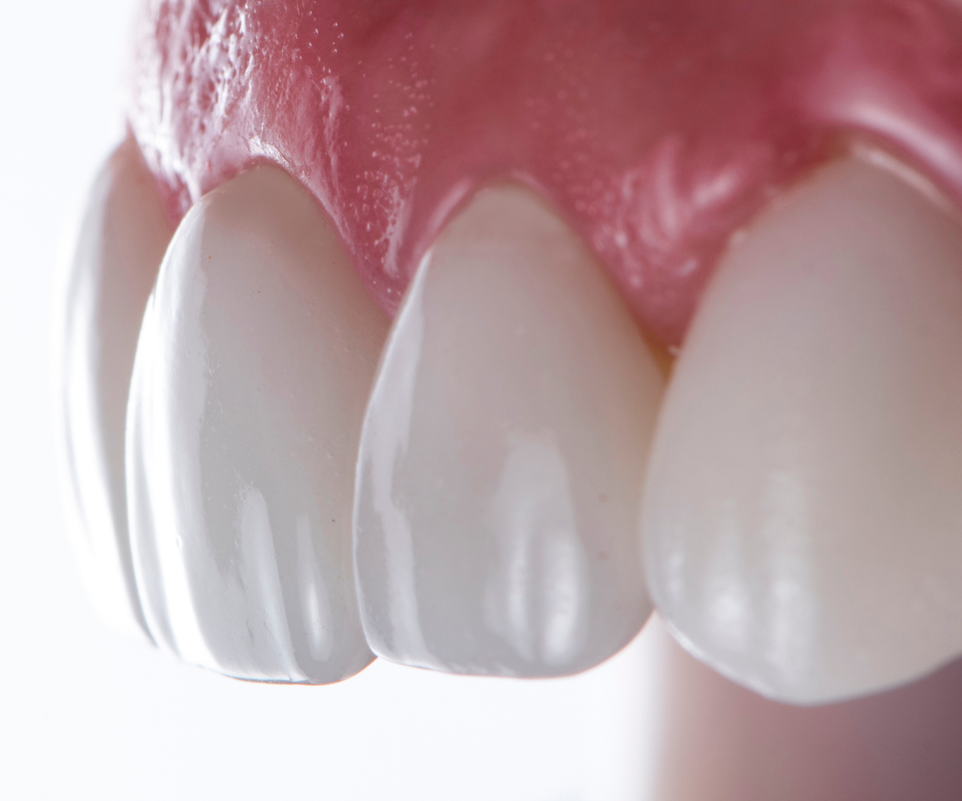 Konya yaprak porselen diş uygulaması sonrası ön dişlerde estetik laminate veneer görünümü.