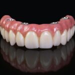 Konya full mouth implant tedavisi ile tüm ağız sabit implant protez uygulamasını gösteren diş hekimliği görseli.