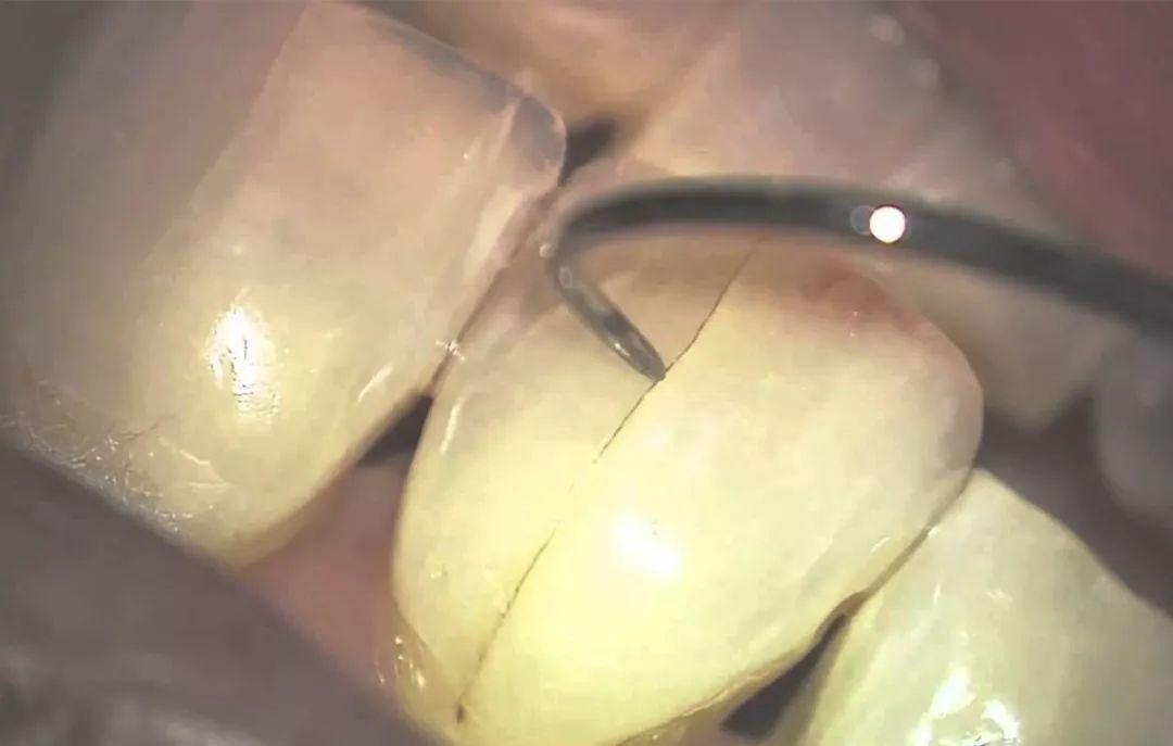 Diş çatlağını, mine yüzeyindeki ince çizgileri ve diş hekimi muayenesini gösteren dental bilgilendirme görseli.