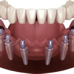 Konya All-on-4 ve All-on-6 implant tedavisi ile sabit tam diş protezi uygulamasını gösteren diş hekimliği görseli.