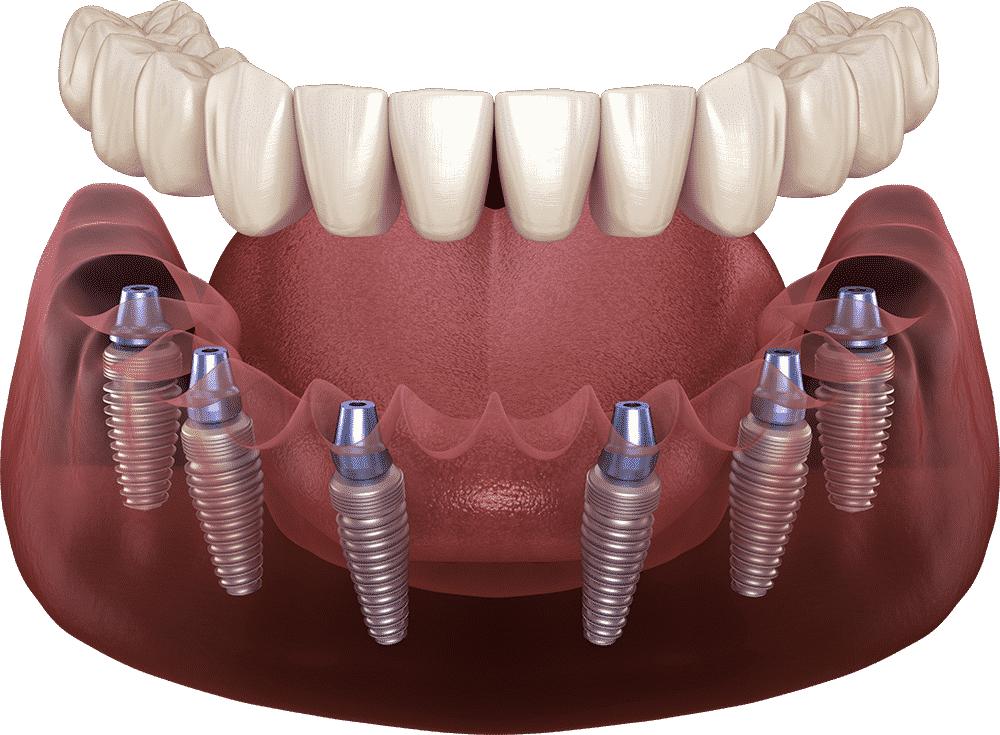 Konya All-on-4 ve All-on-6 implant tedavisi ile sabit tam diş protezi uygulamasını gösteren diş hekimliği görseli.