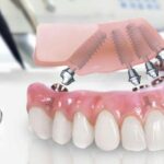 Konya implant tedavisi sürecinde implant yerleştirme ve protez aşamasını gösteren diş hekimliği görseli.