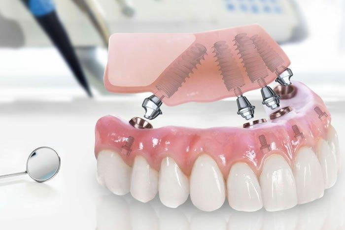 Konya implant tedavisi sürecinde implant yerleştirme ve protez aşamasını gösteren diş hekimliği görseli.