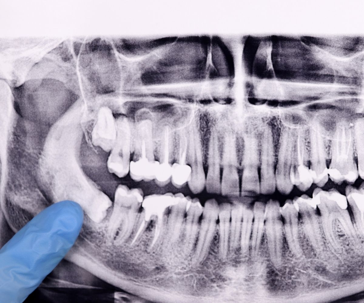 Konya gömülü diş tedavisi için panoramik röntgen değerlendirmesi