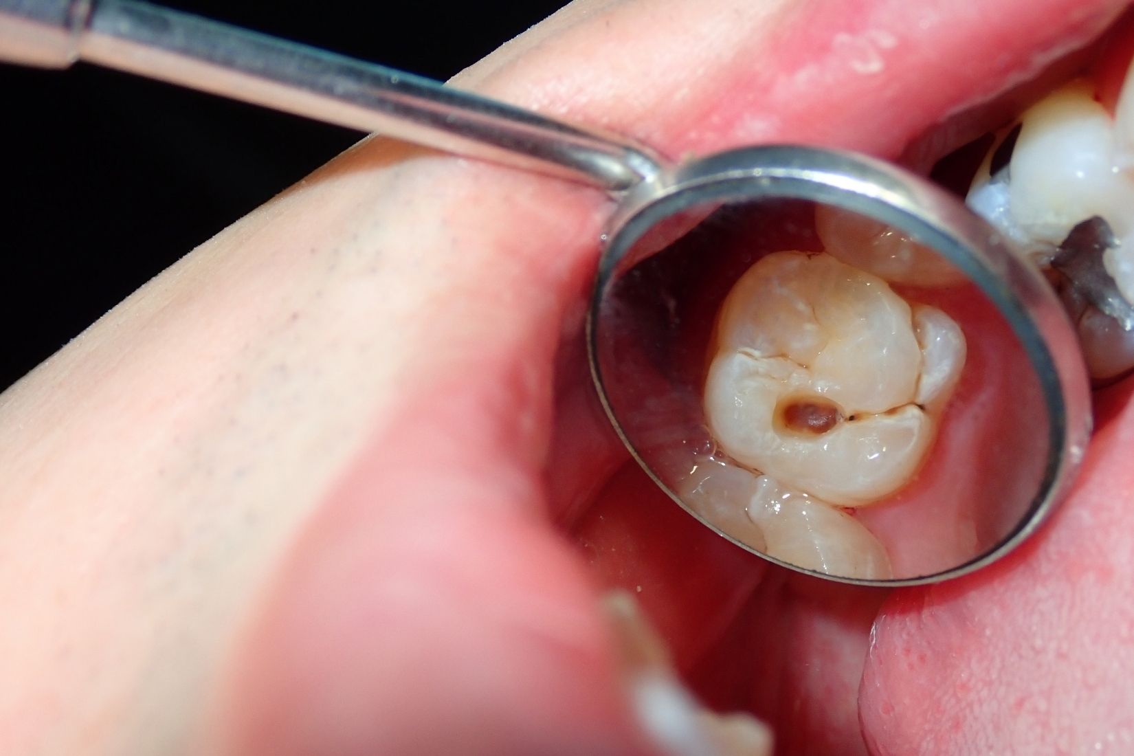 Diş çürüğünün başlangıç aşamalarını, plak oluşumunu ve mine tabakasındaki değişimleri gösteren dental görsel.