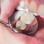 Dolgu sonrası diş hassasiyeti, çiğneme ağrısı ve diş hekimi kontrolünü gösteren bilgilendirici dental görsel.