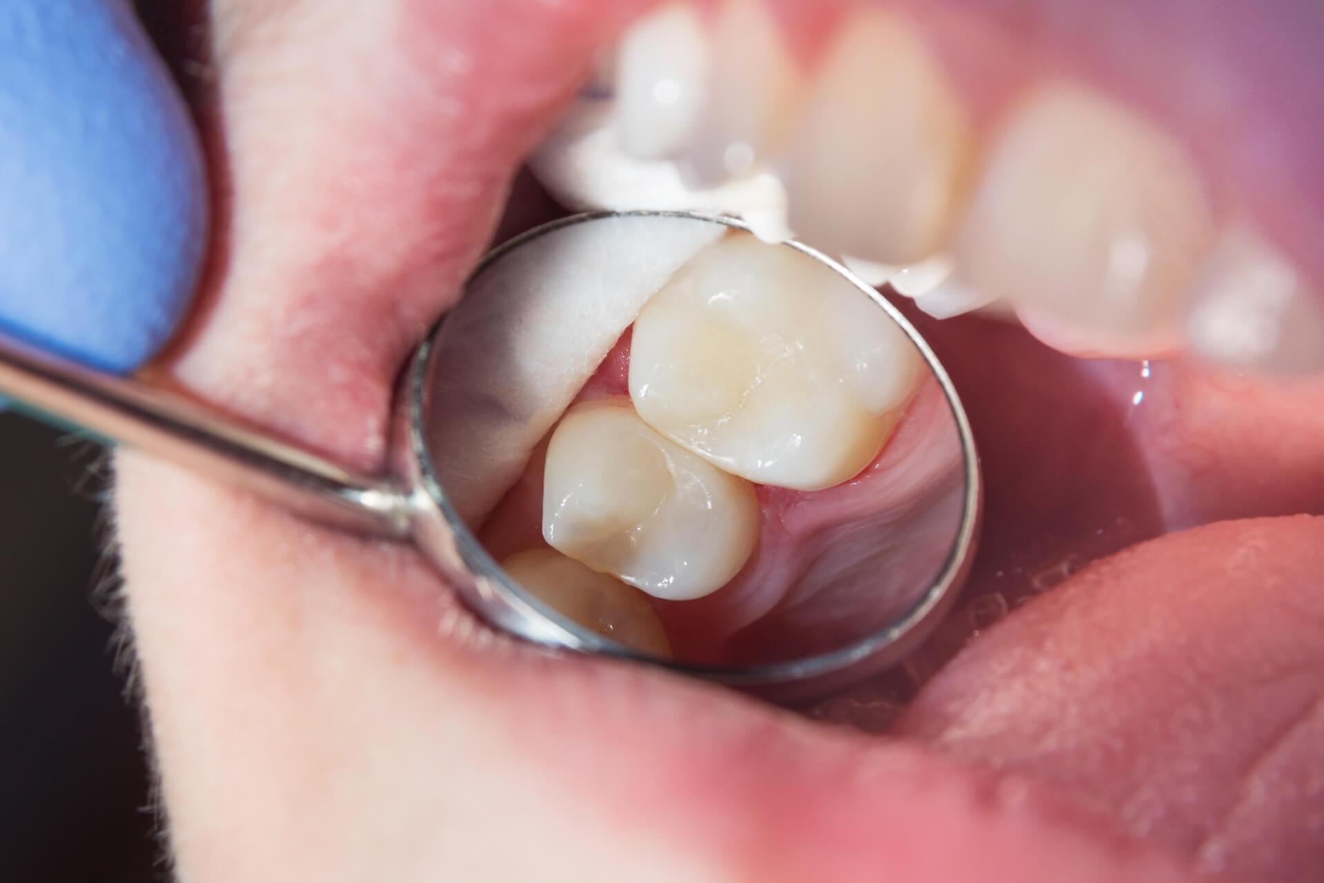 Dolgu sonrası diş hassasiyeti, çiğneme ağrısı ve diş hekimi kontrolünü gösteren bilgilendirici dental görsel.