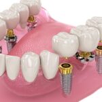 Konya full mouth implant tedavisi, All-on-4 sistemi ve implant üstü sabit protez planlamasını gösteren dental görsel.