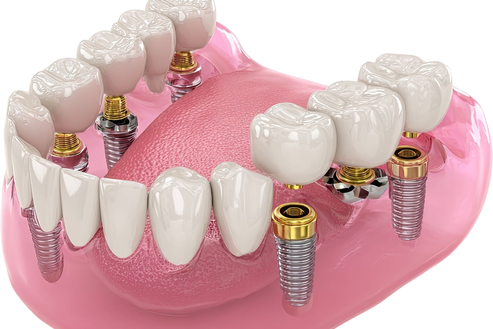 Konya full mouth implant tedavisi, All-on-4 sistemi ve implant üstü sabit protez planlamasını gösteren dental görsel.