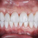 Ön diş estetiğinde beyazlatma, bonding, porselen lamine ve gülüş planlamasını gösteren bilgilendirici dental görsel.