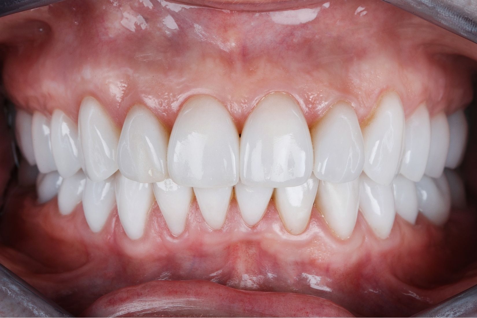 Ön diş estetiğinde beyazlatma, bonding, porselen lamine ve gülüş planlamasını gösteren bilgilendirici dental görsel.