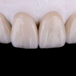 Konya lamina diş uygulamaları, porselen yaprak diş ve gülüş tasarımı planlamasını gösteren dental görsel.