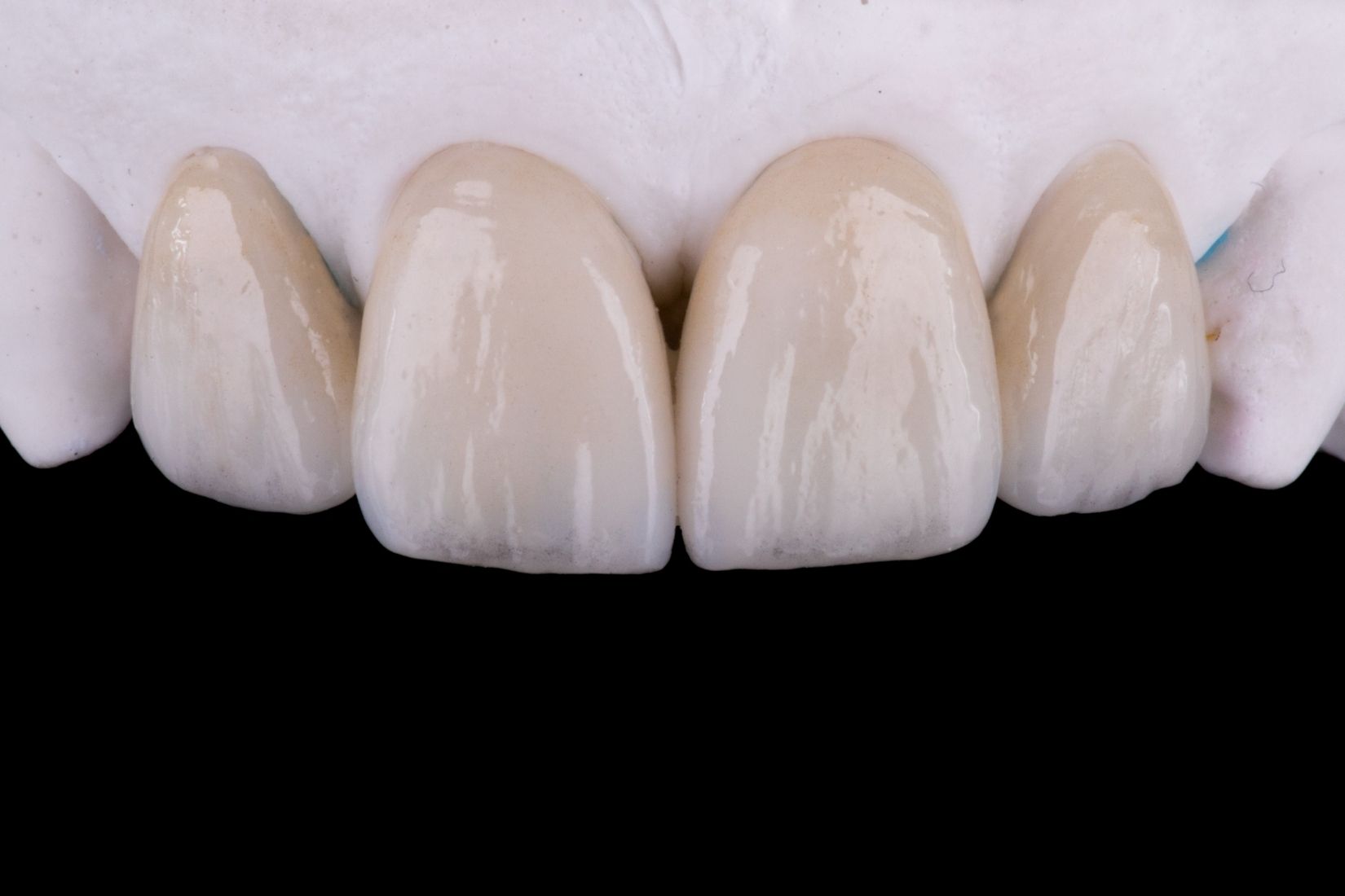 Konya lamina diş uygulamaları, porselen yaprak diş ve gülüş tasarımı planlamasını gösteren dental görsel.