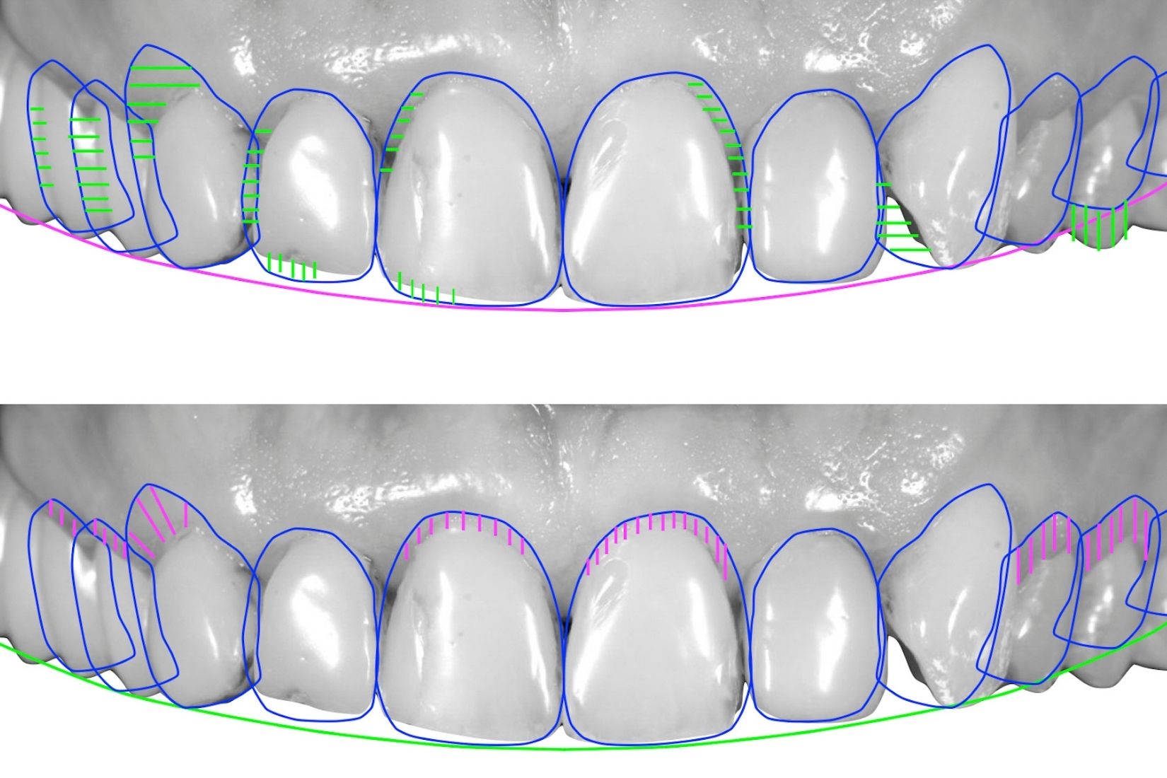 Konya ön diş estetiği uygulamalarında lamina, bonding ve gülüş tasarımı planlamasını gösteren dental görsel.