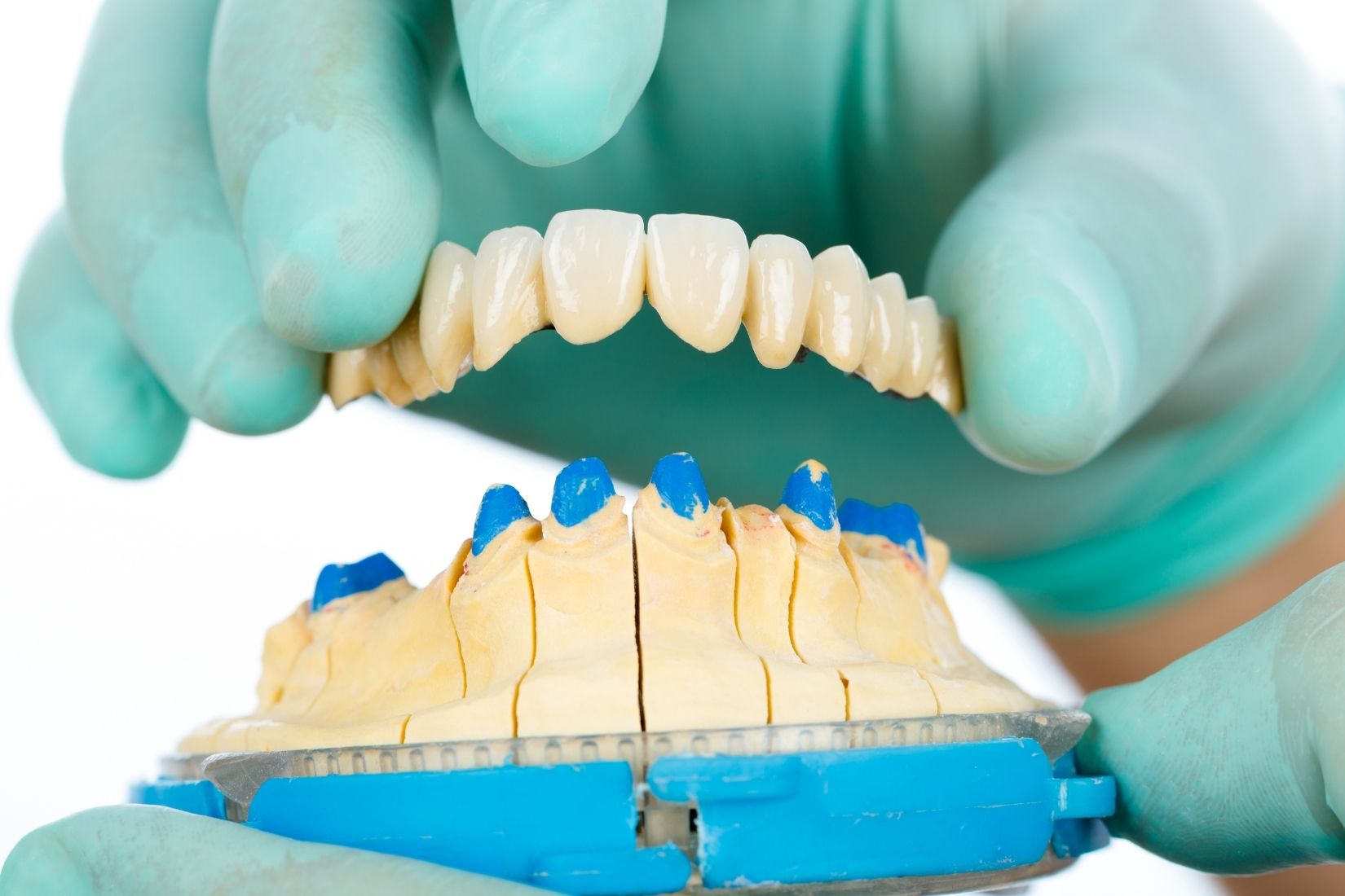 Konya porselen diş kaplama süreci, estetik kaplama planlaması ve diş hekimi muayenesini gösteren dental görsel.