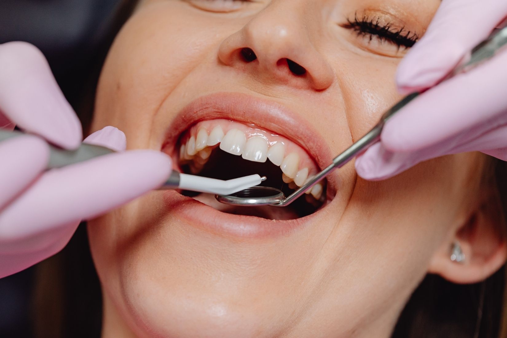 Diş eti seviyesi, gülüş estetiği ve sağlıklı diş eti görünümünü gösteren bilgilendirici dental görsel.