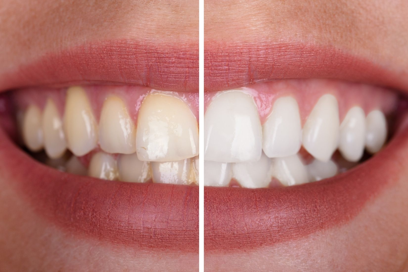 Konya’da diş beyazlatma planlamasında renk analizi ve diş muayenesini gösteren bilgilendirici dental görsel.