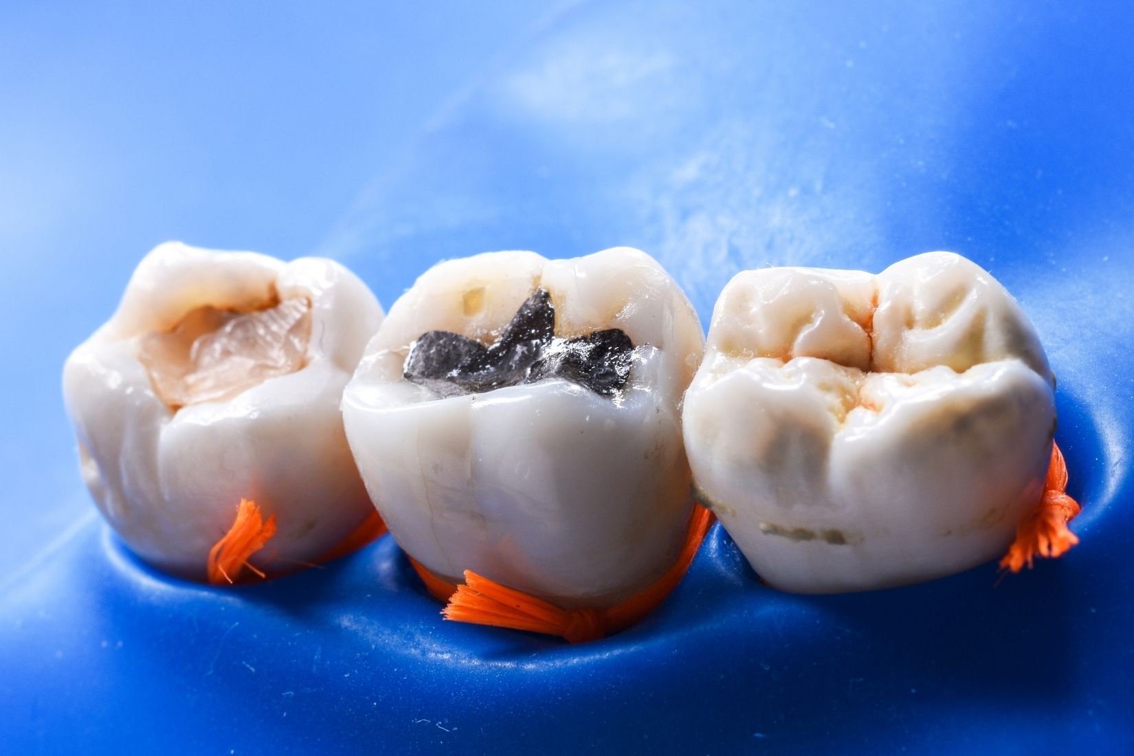 Konya’da diş dolgusu planlaması, çürük muayenesi ve kompozit restorasyon aşamalarını gösteren bilgilendirici dental görsel.