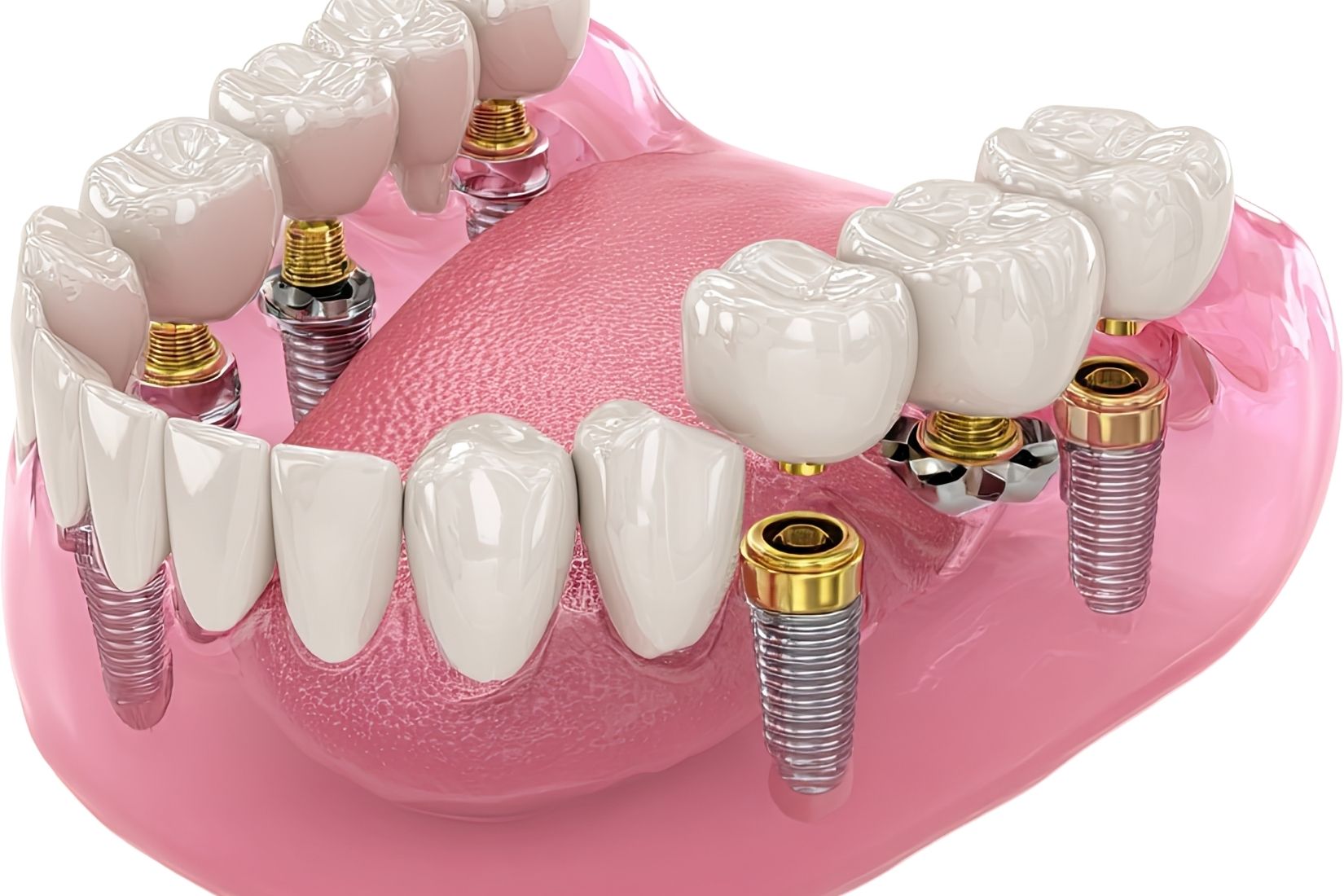 Konya’da implant üstü protez planlaması, abutment seçimi ve sabit protez aşamalarını gösteren bilgilendirici dental görsel.