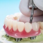 Vidalı implant üstü protezin implant üzerine yerleştirilmesini ve bağlantı sistemini gösteren dental görsel.