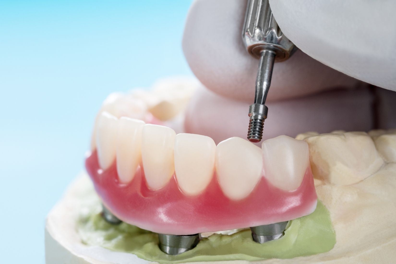 Vidalı implant üstü protezin implant üzerine yerleştirilmesini ve bağlantı sistemini gösteren dental görsel.
