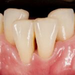 Diş eti çekilmesi, açığa çıkan kök yüzeyi ve periodontal değerlendirmeyi gösteren bilgilendirici dental görsel.