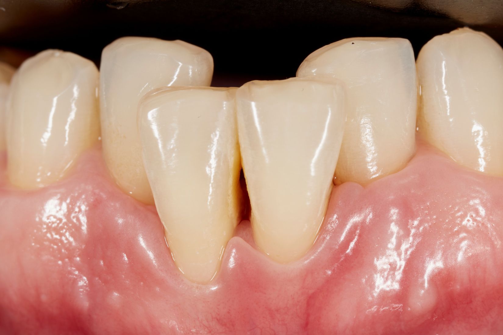 Diş eti çekilmesi, açığa çıkan kök yüzeyi ve periodontal değerlendirmeyi gösteren bilgilendirici dental görsel.