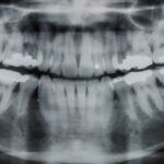 Konya gömülü diş ameliyatında yirmi yaş dişinin konumu ve cerrahi çekim planlamasını gösteren bilgilendirici dental görsel.