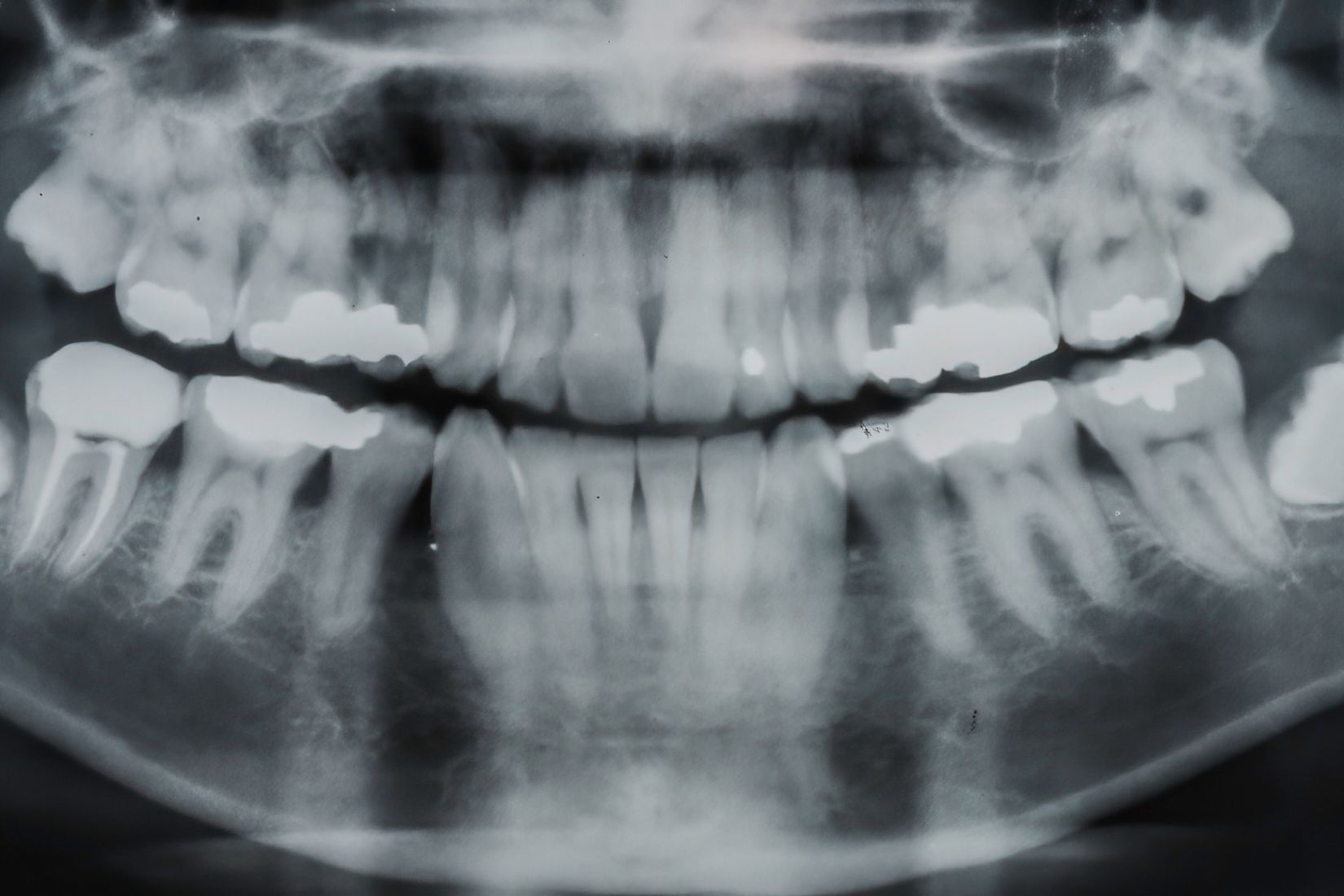 Konya gömülü diş ameliyatında yirmi yaş dişinin konumu ve cerrahi çekim planlamasını gösteren bilgilendirici dental görsel.
