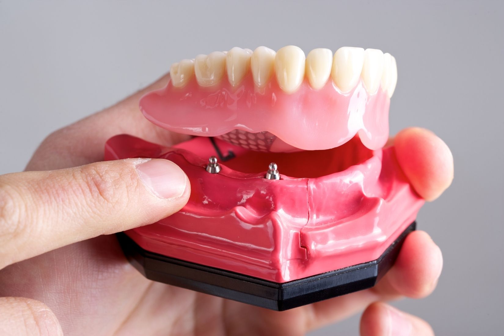 Konya Toronto protezi, tam çene implantları ve sabit implant üstü protez planlamasını gösteren bilgilendirici dental görsel.