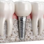 Dental implant çevresinde yeni kemik oluşumunu ve osseointegrasyon sürecini gösteren bilgilendirici tıbbi görsel.