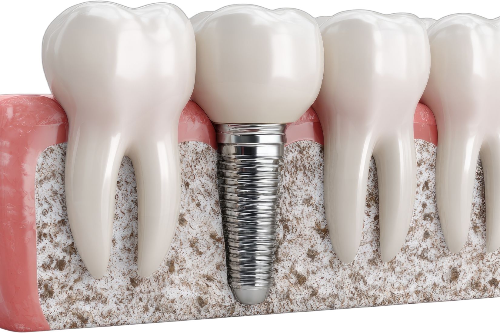 Dental implant çevresinde yeni kemik oluşumunu ve osseointegrasyon sürecini gösteren bilgilendirici tıbbi görsel.