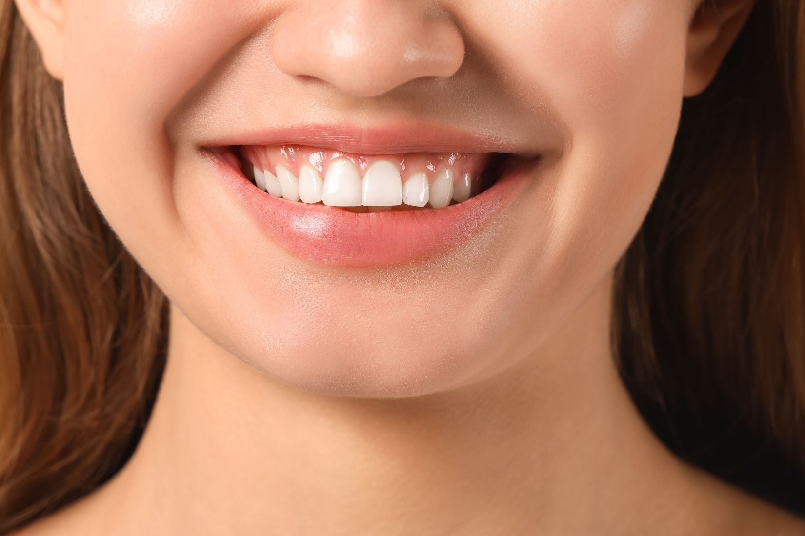 Dişler arasında oluşan diş eti şişliği ve interdental papil değişikliklerini gösteren bilgilendirici dental görsel.
