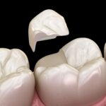 Dolgulu dişte restorasyon ile doğal diş arasındaki kenar sızıntısını ve marjinal uyumu gösteren dental görsel.