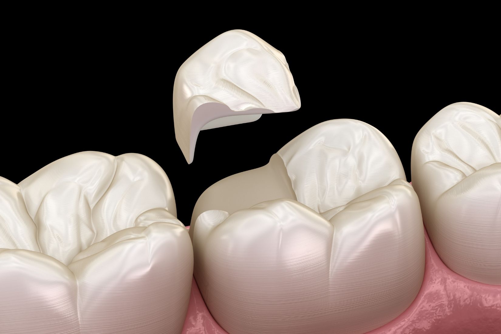 Dolgulu dişte restorasyon ile doğal diş arasındaki kenar sızıntısını ve marjinal uyumu gösteren dental görsel.